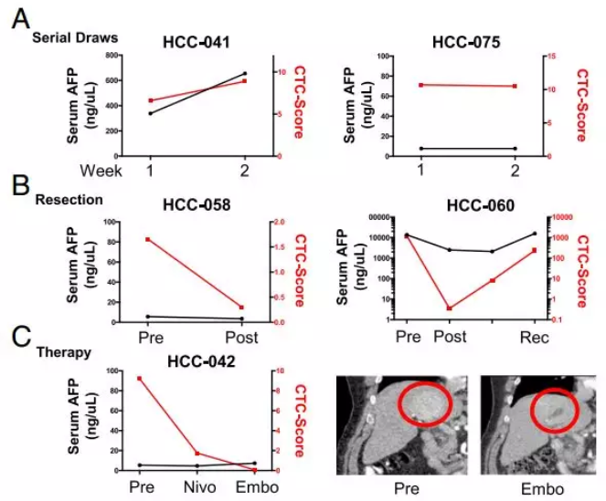圖4.CTC評分較血液AFP檢測系統能夠更靈敏、更特異地檢測肝癌及監控肝癌的治療情況。